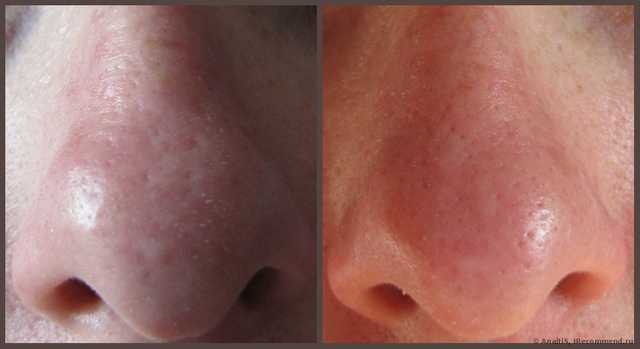 Полоски для носа тони моли отзывы клубника. ochishayushie poloski dlya nosa tony moly egg pore nose pack 13. Полоски для носа тони моли отзывы клубника фото. Полоски для носа тони моли отзывы клубника-ochishayushie poloski dlya nosa tony moly egg pore nose pack 13. картинка Полоски для носа тони моли отзывы клубника. картинка ochishayushie poloski dlya nosa tony moly egg pore nose pack 13. Рискнула использовать пластырь Tony Moly, потому что бездумно повелась на хорошие отзывы и поверила в чудо-действие корейской косметики. Оказалось, зря.