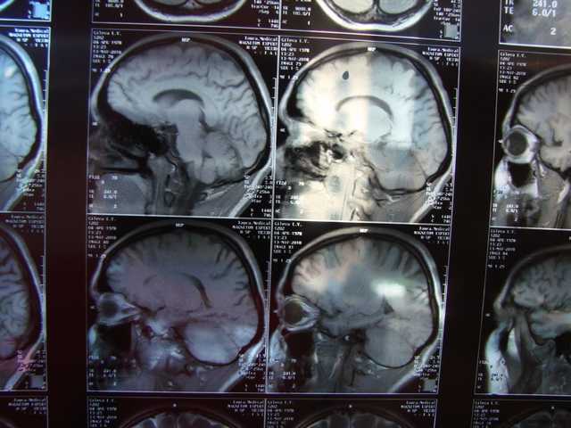 Фрагмент МРТ головного мозга