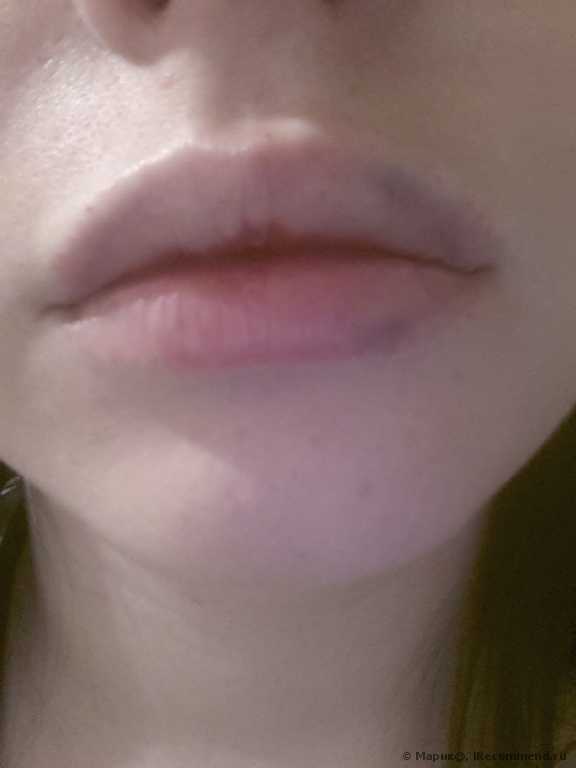 Juvederm Ultra 3. Почему именно он? Обновлён )
