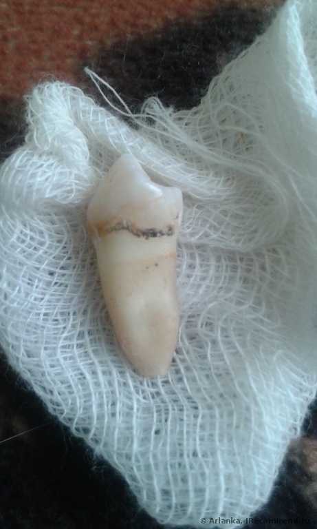 Удаление зубного камня - фото