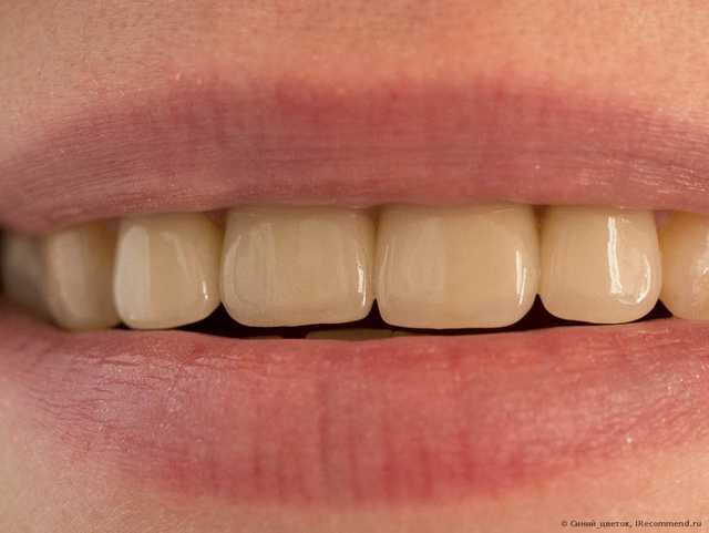 Протезирование зубов. Безметалловые керамические коронки - фото
