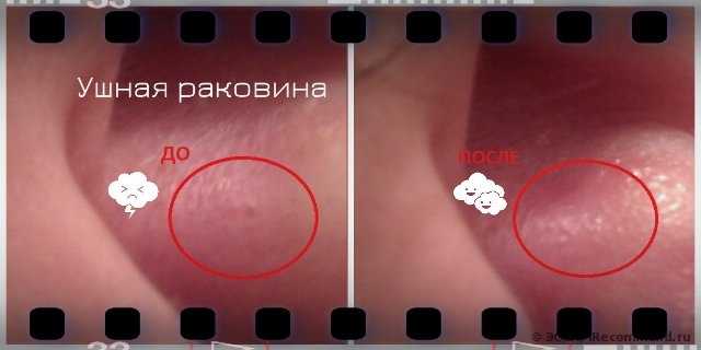 Собрала все черные точки в кучку. Рекомендую супер штучку!!! (коллажи агрегата и результата, ВПЕЧАТЛИТЕЛЬНЫМ НЕ ЗАХОДИТЬ)