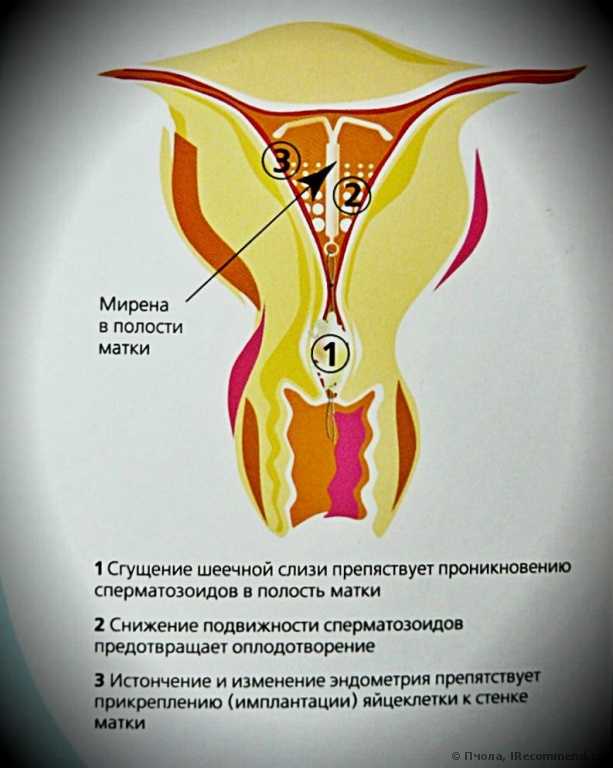 Спираль отзывы. Мирена в полости матки. Расположение спирали Мирена в матке. Спираль маточная гормональная. ВМС Мирена менструационного цикла.