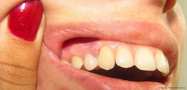 Съемные зубные протезы - фото