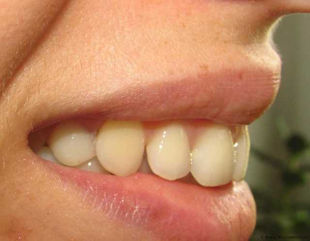 Съемные зубные протезы - фото