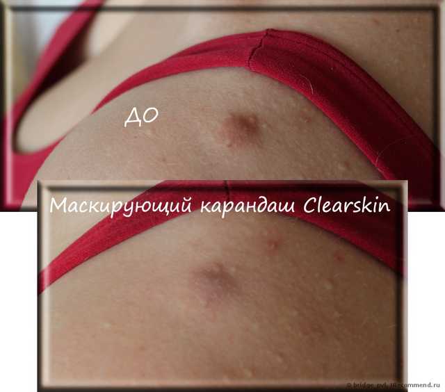 Маскирующий карандаш Clearskin. ДО и ПОСЛЕ