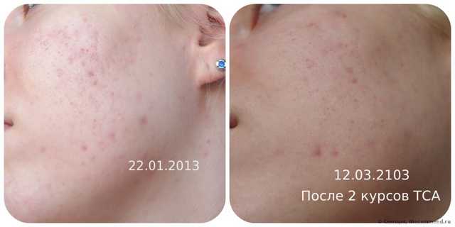 Косметическая процедура - химический пилинг трихлоруксусной кислотой - фото