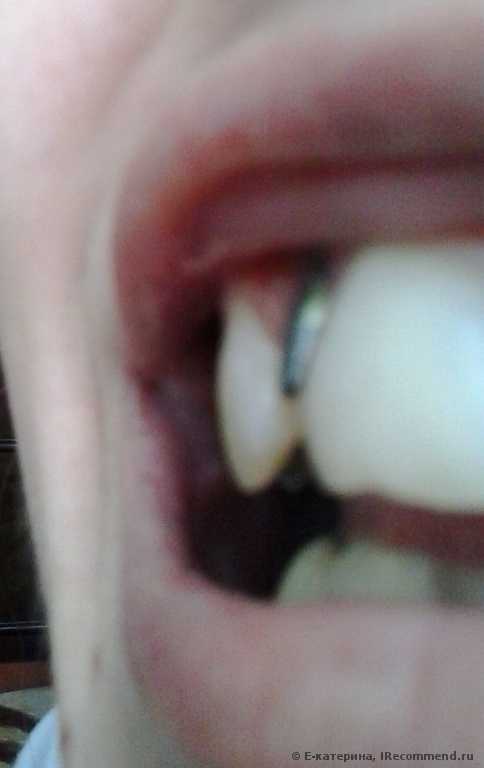 Имплантация зуба, зубной имплант. - фото
