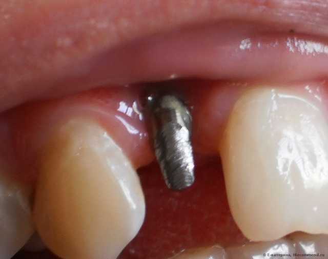 Имплантация зуба, зубной имплант. - фото