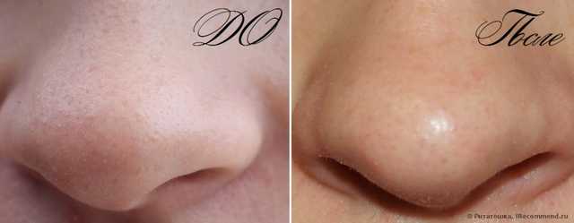 Инструмент для чистки лица и пор Aliexpress 2 x Stainless Steel Blackhead Pimples Acne Needle Tool - фото