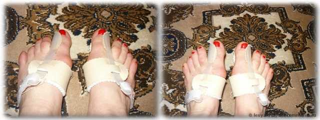 Корректор большого пальца ноги Aliexpress Bunion Splint Great Toe Straightener Foot Pain Relief Hallux Valgus - фото