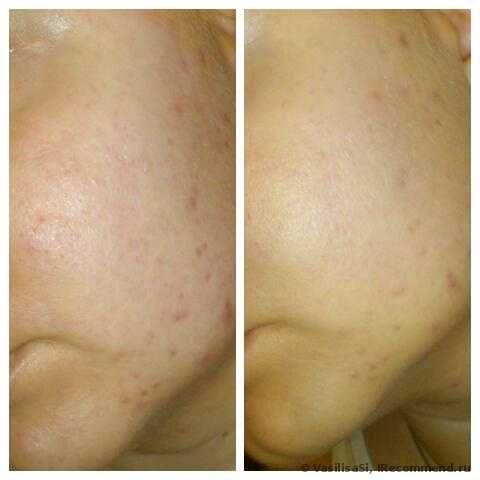 CC Cream Eveline комплексный успокаивающе-увлажняющий крем для сосудистой кожи 8 в 1 - фото