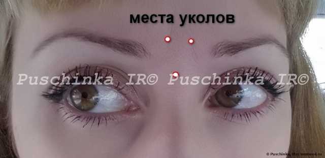 Инъекции ботокса - фото