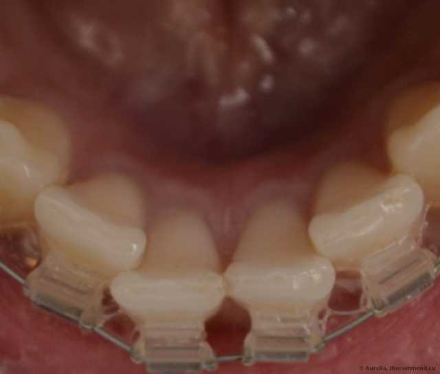 Ультразвуковая чистка зубов - фото
