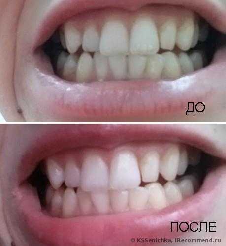 Ультразвуковая чистка зубов - фото
