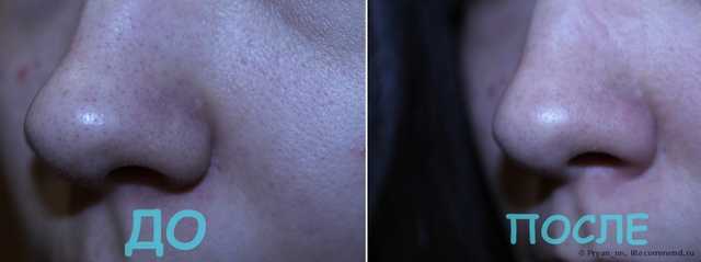 Очищающие полоски для носа Флоресан Spring skin для очищения пор носа и подбородка - фото