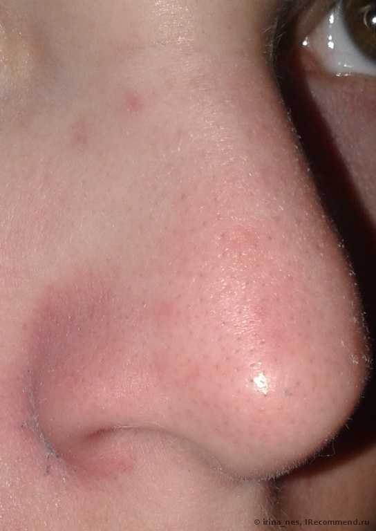 Нос после использования полоски