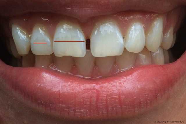 Лазерное отбеливание зубов - фото