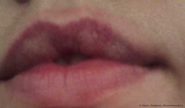 Пластырь для губ от герпеса silkoplast отзывы thumbnail