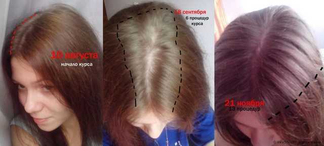 Мезотерапия волос и головы - фото