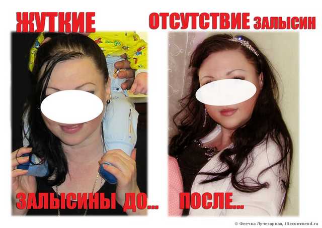 Плазмолифтинг кожи головы - фото