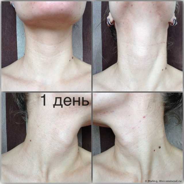 Еще видны следы уколов
