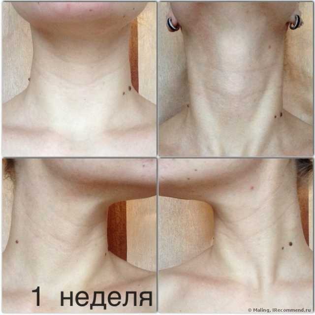 Инъекционная мезотерапия. Полный фотоотчет.
