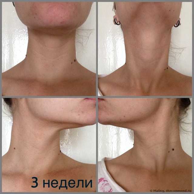Инъекционная мезотерапия. Полный фотоотчет.