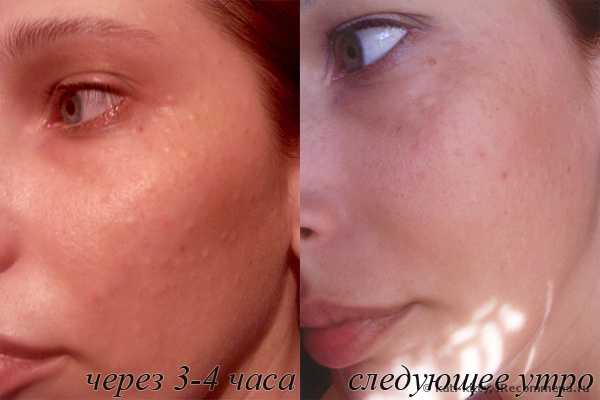 Ревитализация препаратом Dermaheal или поговорим о лысых ежах