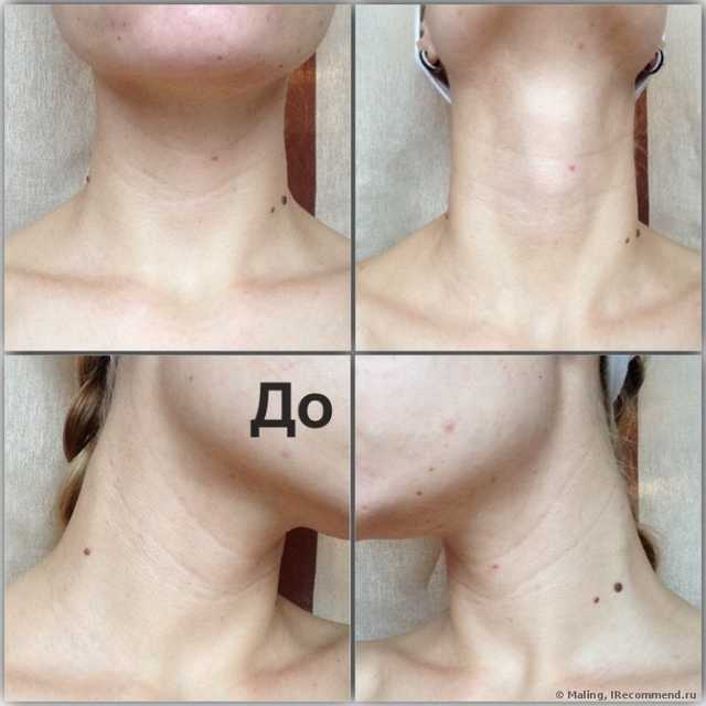 Инъекционная мезотерапия. Полный фотоотчет.