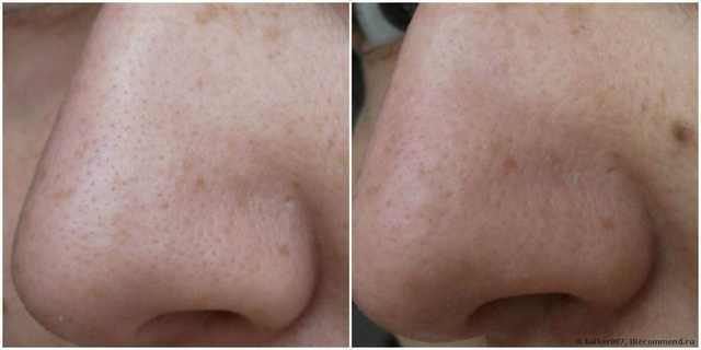 Инструмент для чистки лица и пор Aliexpress Blackhead Comedone Acne Pimple Blemish Extractor Remover Stainless Needles - фото