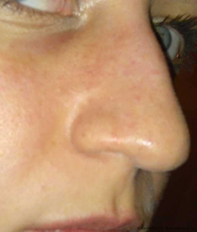 Лазерное удаление (коагуляция) сосудов на лице - фото