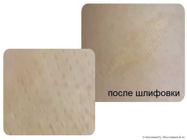 Одна шлифовка рубцов не дала результата, т. к. нужен курс процедур (фото до/во время заживления/спустя 3 мес.)