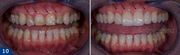 Зубные коронки из циркония (безметалловые)
