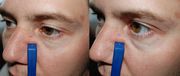 Лазерное удаление (коагуляция) сосудов на лице