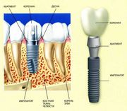 Имплантация зуба,зубной имплант.