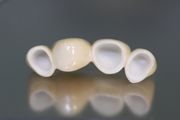 Протезирование зубов. Безметалловые керамические коронки