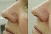 Удаление звездочки на лице фотовспышкой (фотокоагуляция) Удаление звездочки на лице фотовспышкой (фотокоагуляция)