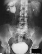 Цистография - рентгенологический метод исследования мочевого пузыря