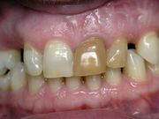 Внутриканальное  отбеливание зубов (Эндоотбеливание)