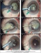 Хирургическое лечение катаракты (экстракция катаракты)